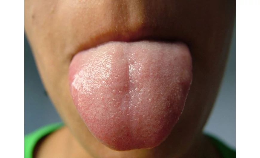 Mit jelent a fehér nyelv és mik az okai?